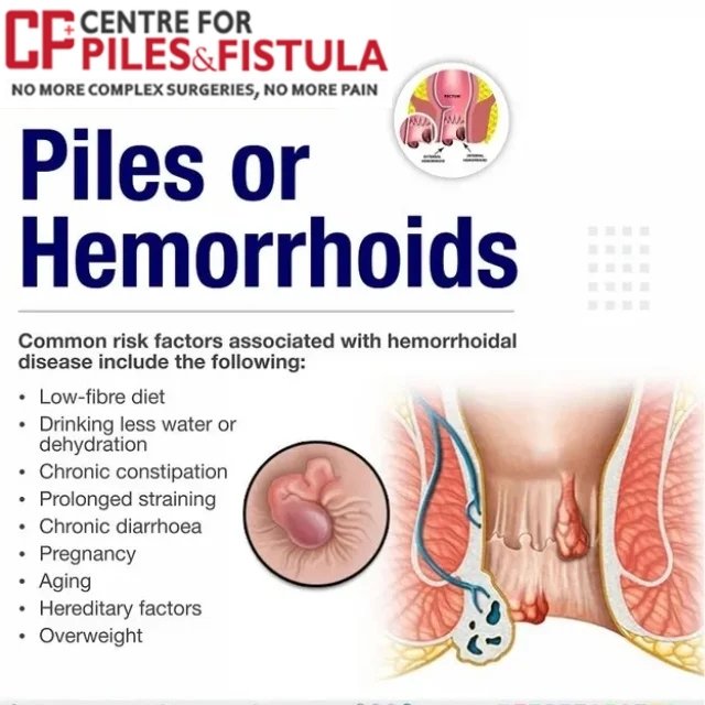 PIles Treatment in Rohini